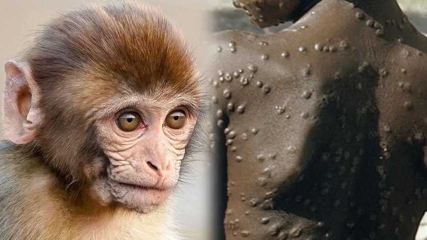 La OMS eleva a 131 los casos de viruela del mono, un tercio de ellos en España