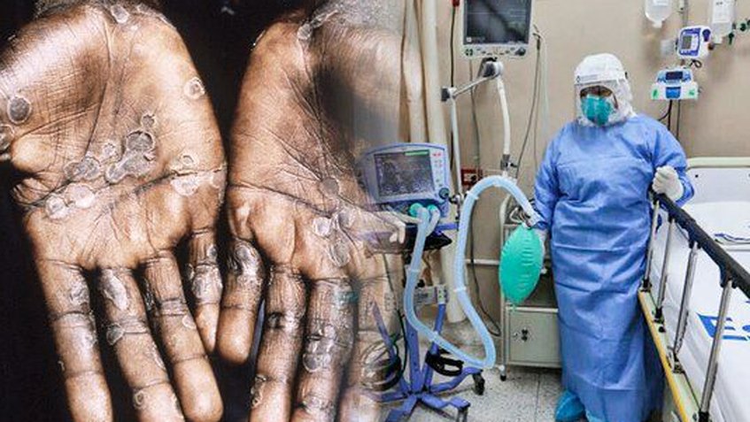 Hay más de 50.000 casos de viruela del mono en todo el mundo según la OMS