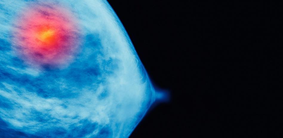 Ensayos dirigidos al tratamiento del cáncer de mama