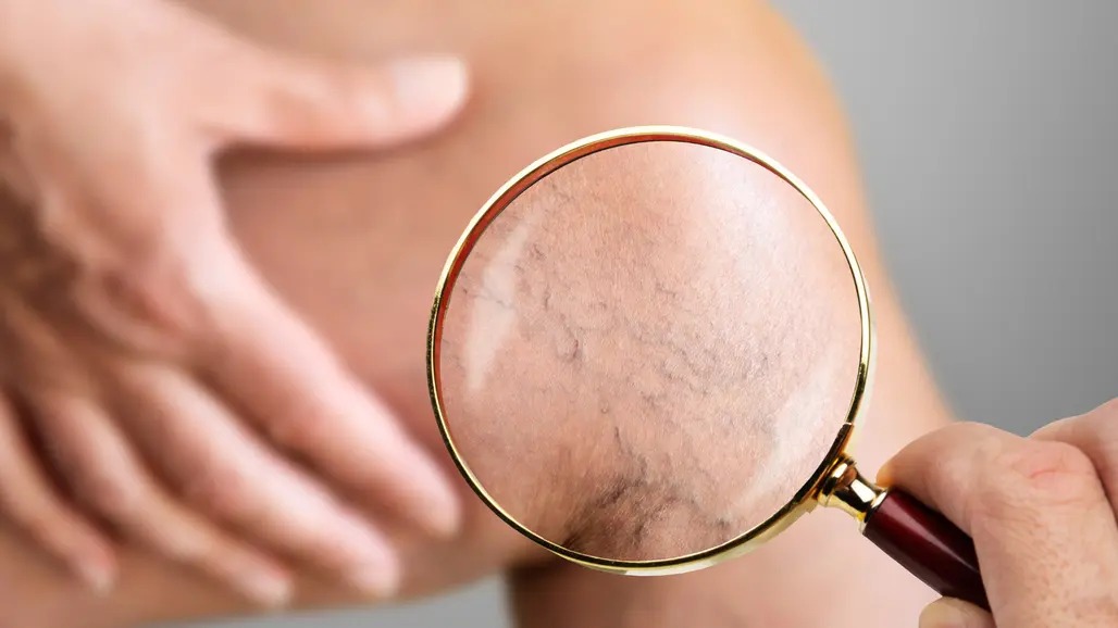 ¡Salud cardiovascular! ¿Cómo mejorar los síntomas de las varices? Los consejos de los médicos de Atención Primaria