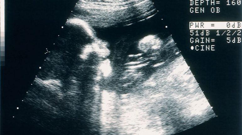 Operaron el cerebro de un feto por primera vez en la historia