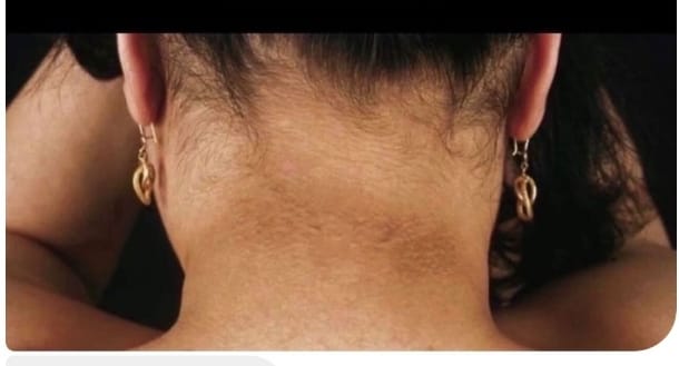 Si tienes más de 20 kg de sobrepeso y aparecen estas manchas en el cuello y en axilas es hora de tomar medidas