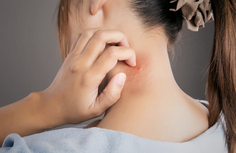 La enfermedad compleja el lupus afecta más a las mujeres