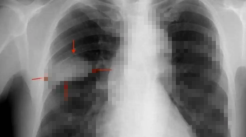 Conoce|Identifican nuevos biomarcadores del cáncer de pulmón
