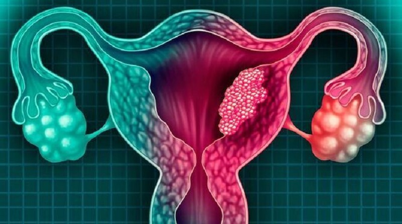 Entérate|¿Puede llegar a su fin el cáncer de útero?