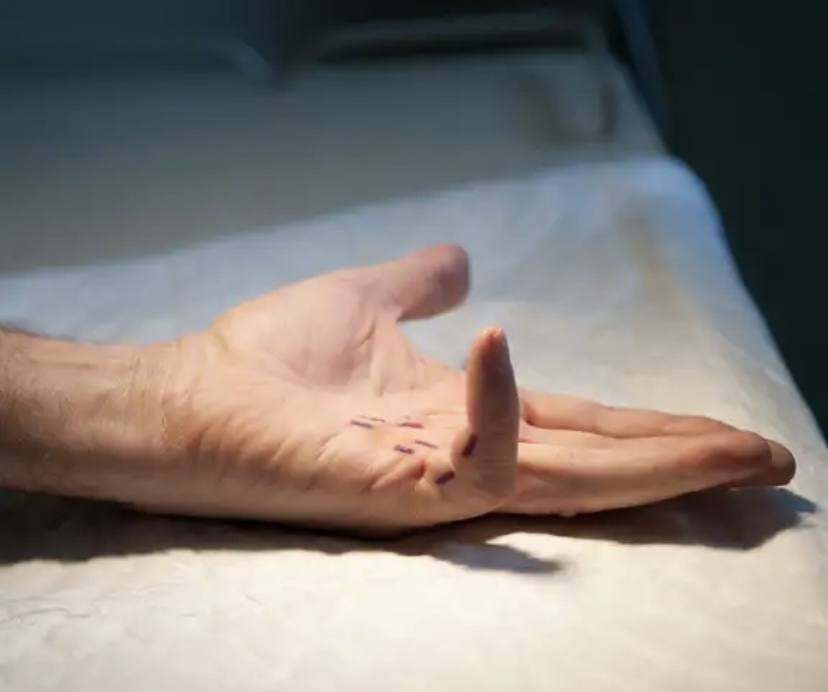 «Enfermedad de los vikingos» sería por herencia neandertal