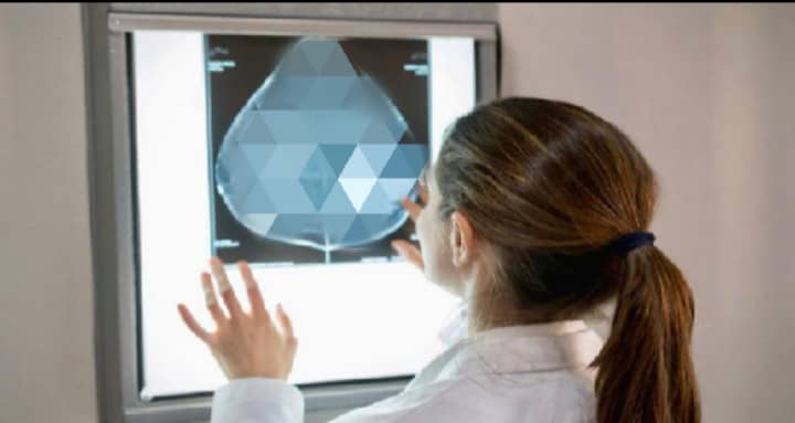 Crean predictor que determina supervivencia de pacientes con cáncer de mama