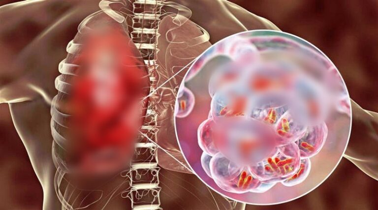 OMS lanza plataforma digital para brindar mayor atención al tema de tuberculosis