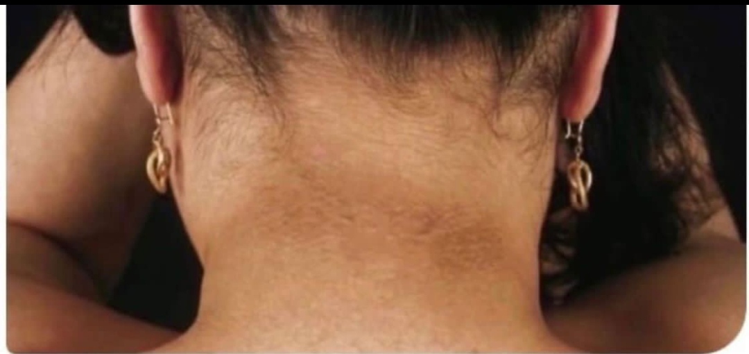 Si tienes más de 20 kg de sobrepeso y aparecen estás manchas en el cuello y en las axilas es hora de tomar medidas