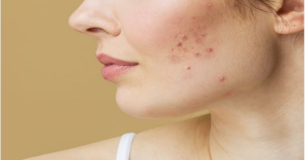 ¿Qué hace la vitamina C en el rostro cuando se sufre de acné?