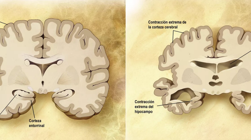 Infecciones causadas por hongos pueden provocar síntomas de Alzheimer