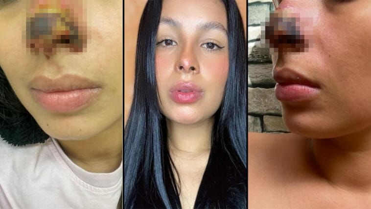 Esta mujer casi pierde su nariz por inyectarse ácido hialurónico (+ Video)