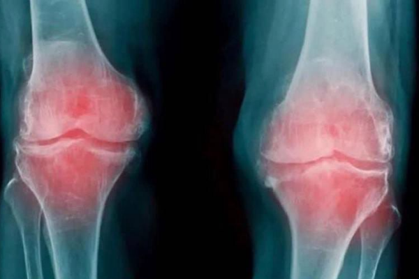 ¿Te duele la rodilla? Cuidado, podría ser artrosis y aquí te contamos cuáles son sus síntomas (+ Video)