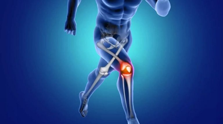 Conoce|Estudio revela que cristales de calcio en la rodilla acelera la artritis