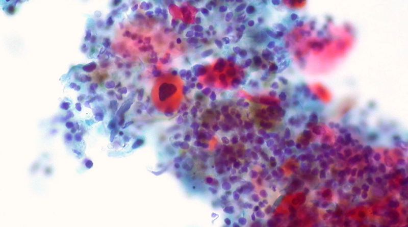 Científicos descubren “eslabón perdido” entre la dieta y el riesgo de cáncër