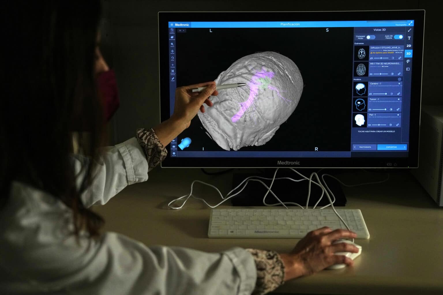 ¿Qué es el Donanemab, el segundo medicamento aprobado en EE UU para tratar el alzhéimer?