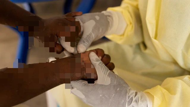 ¿Qué es el mpox, cómo se contagia y cómo se puede prevenir? (+ Detalles)