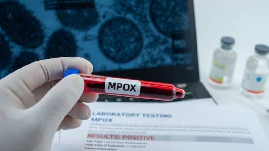 Mérida establece protocolos epidemiológicos para prevenir contagiös de Viruela del Mono