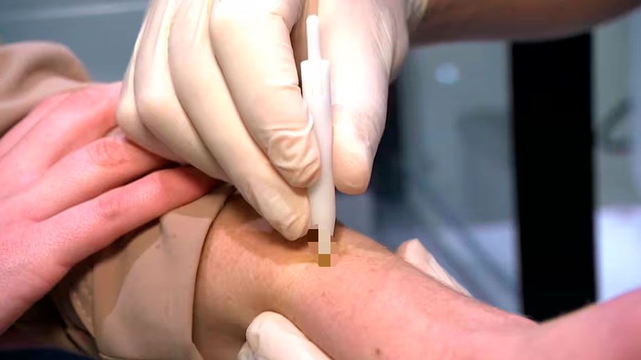 Nueva prueba indolora detectaría en segundos el cáncer de piel