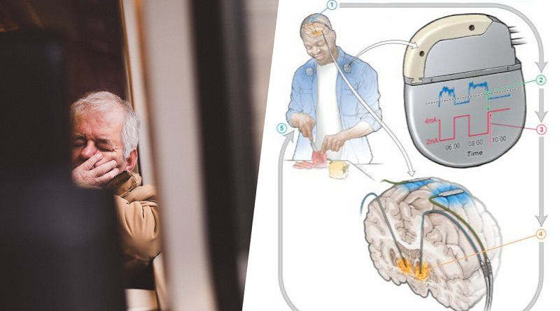 Programa científico desarrolla implante cerebral para el Parkínson (+ Detalles)