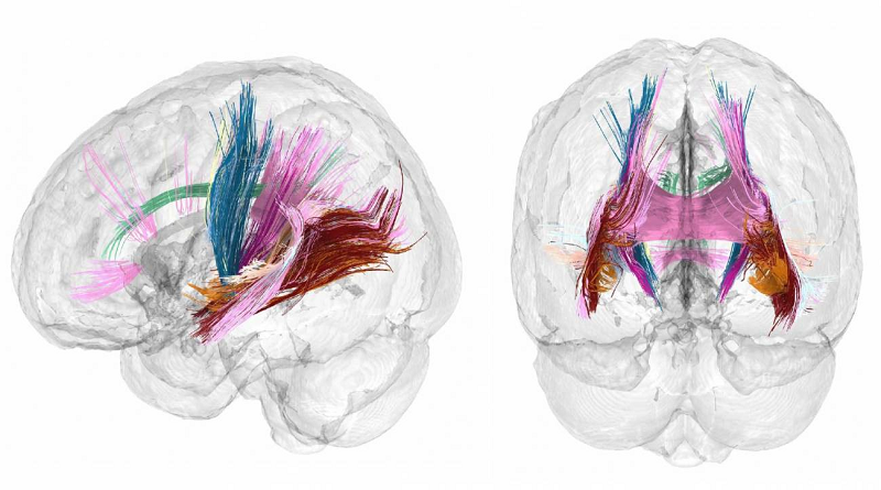 Revelan primer mapa completo de la ‘metamorfosis’ cerebral del embarazo