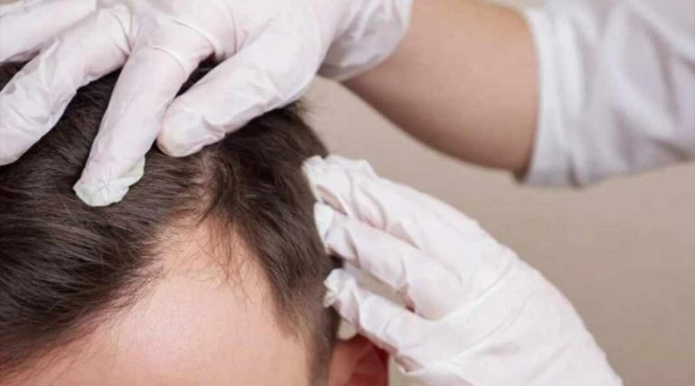 Científicos descubren tratamiento con Células T que podría hacer crecer de nuevo el cabello