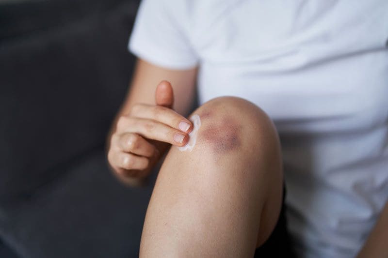 Conozca diversas maneras de eliminar los hematomas o “moretones”