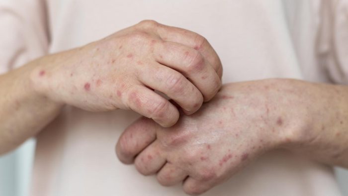 Europa y Asia Central registran el mayor número de casos de sarämpión en 25 años