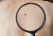 Descubren cómo el melanöma y otros tümores se ocultan para eludir la inmunoterapïa (+ Detalles)