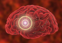 Cuál es el factor que aumenta el rïesgo de ACV durante al menos una década (+ Detalles)