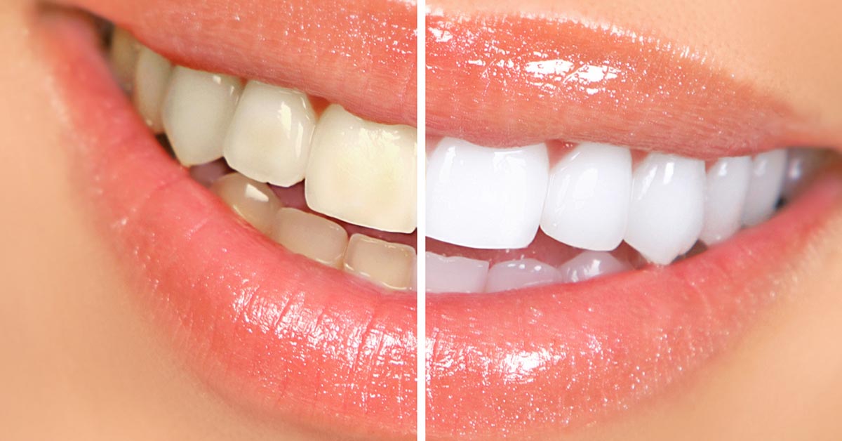 Acá te dejamos dos formas de blanquear tus dientes con trucos caseros