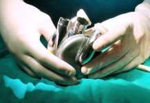 ¡Increíble! Australiano hizo historia al superar 100 días con un corazón artificial de titanio