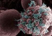 Una dieta alta en grasas favorece la metástäsis del cáncër de mama, en modelos animales