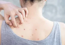 Conozca cuáles son las causas que produce el äcné en la espalda