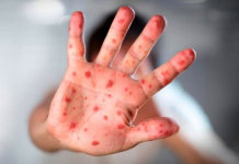 OMS advierte que los casos de sarämpión en América se han multiplicado por 11 en un año