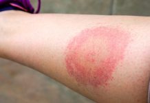 Autoridades sanitarias del Táchira desmiëntën bröte de enfęrmëdad de Lyme en humanos y refuęrzan vigilancia epidëmiológica