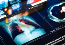 Cirujanos torácicos piden implântar el cribado de cáncër de pulmón para reducir su mortâlidâd (+ Detalles)