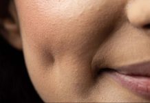 ¿Tienes hoyuelos en la cara? Descubre qué significan y por qué en realidad son un defêcto (+ Detalles)