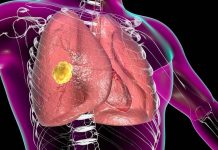 La infêcción por hôngos que puede contraerse a través del aire: estos son los síntomas y principales tratamientos (+ Detalles)