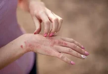 Dermâtitis en los meses calurosos: así afêctan el polen, el sudor y el calor a tu piel sensible (+ Detalles)