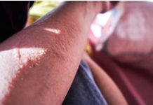 La ‘alergia’ al sol en verano: qué es realmente, cómo tratarla y prevenirla (+ Detalles)