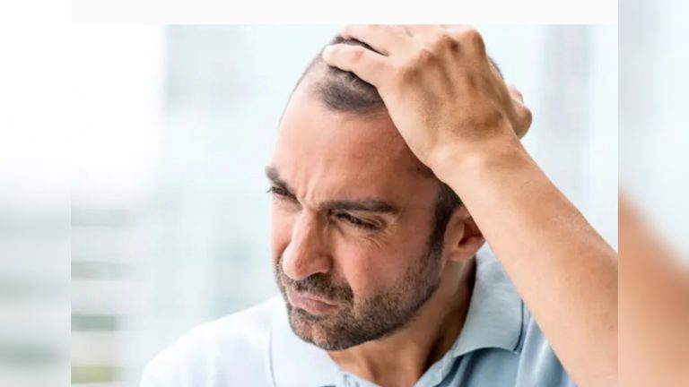 El verdadero daño de la alopecïa está en la cabeza pero no es la pérdida de cabello (+ Detalles)