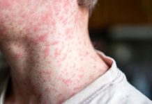 Estados Unidos alcanzó una cifra récord de casos de sarampïón en lo que va de 2025