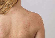 ‘Bacné’: mitos y verdades sobre los granitos en la espalda que se pueden extender por muchos años (+ Detalles)