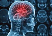 Microinfârtos cerëbrales: cómo identificar este tipo de accïdente cerebrôvascular (+ Detalles)