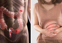 Cáncër de colon y síndröme del intestino irritable: cómo reconocer y diferenciar los síntomas de cada enfêrmêdad (+ Detalles)