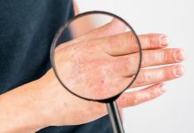 Distinguir entre eccęma o psorïasis permite elegir el tratamiento adecuado y mejorar la calidad de vida (+ Detalles)