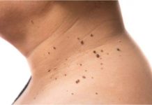 Factores que promueven la aparición de verrügas en el cuello y cómo prevenirlas (+ Detalles)