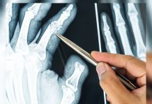 Descubren cómo la vitamina D podría convertirse en el aliado secreto para prevenir la osteoporosis y fortalecer huesos
