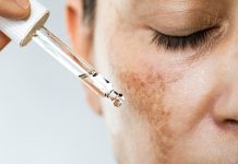 ¿Manchas en el rostro? Descubre los factores hormonales y genéticos que desencadenan el melasma y aprende a proteger tu piel